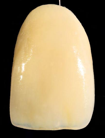 5 or beige modifier one degree darker than the subsequent tooth colour.
