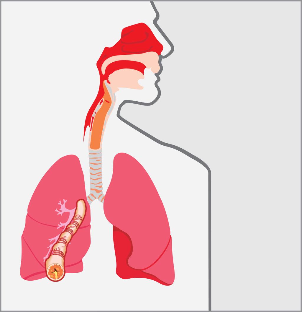 Pathophysiology: Hypersensitivity of Cough