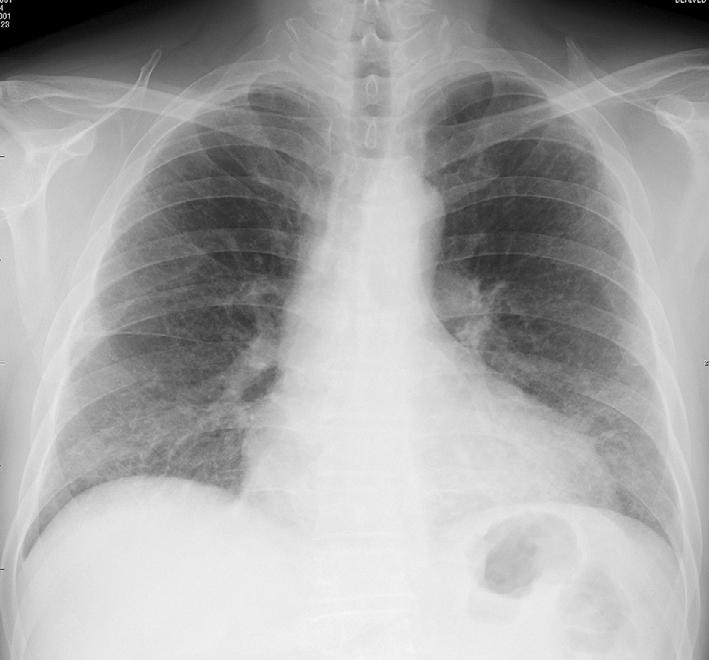 Figure 1. A chest X-ray of Case 1 showing hyperlucency in both upper lung fields and reticular shadows in both lower lung fields. tively) with a normal vital capacity (VC, 106.