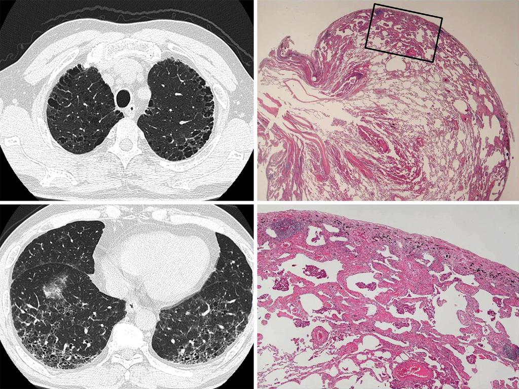Figure 2. A chest high-resolution computed tomography image (left column) and photomicrograph of the biopsied lung tissue (right column) from Case 1.