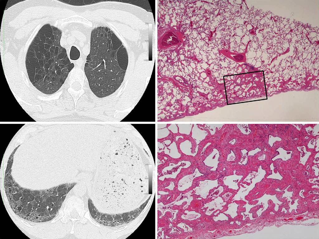 Figure 4. A chest high-resolution computed tomography image (left column) and photomicrograph of the biopsied lung tissue (right column) from Case 2.