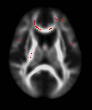 Reduced fractional anisotropy associated with more executive dysfunction R L Red highlights indicate significant positive, partial correlation clusters between executive domain