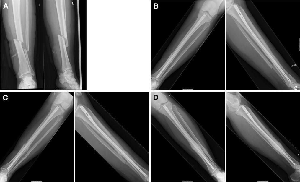 Fig. 1 AP (left) and lateral (right) views preoperative (a), direct postoperative (b), after 2 months (c) and after 9 months (d) of an AO 42-A2 fracture, treated with an intramedullary nail without