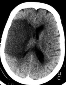Cerebro-vascular stroke CT Terminology Hypodense lesion = lesion of lower density than the normal brain tissue Hyperdense lesion = lesion of higher density than