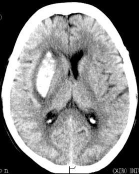 The site of this lesion is identified by its mass effect on the adjacent ventricle and sulci Hypo dense Hyper dense Iso dense Right parietal infarction Right