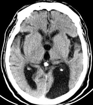 Sub acute infarction Is a hypodense lesion with no edema nor volume loss Right frontotemporooccipital acute infarction with ventricular compression and midline shift Right parietooccipital subacute