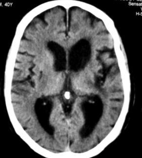 Urgent NCCT done on the same day showed subtle hypodensity in the left deep temporal