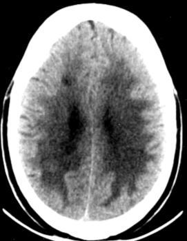 Subcortical arteriosclerotic encephalopathy White matter ischemic changes diffuse