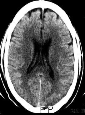 arteriosclerotic encephalopathy appearing as diffuse hypodensity of the white
