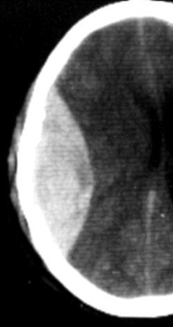 acute or chronic Epidural hematoma Convex inner margin Can cross midline Almost