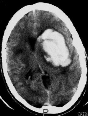 by a rim of hypodense brain edema with consequent mass effect on the left lateral ventricle and contralateral midline shift.