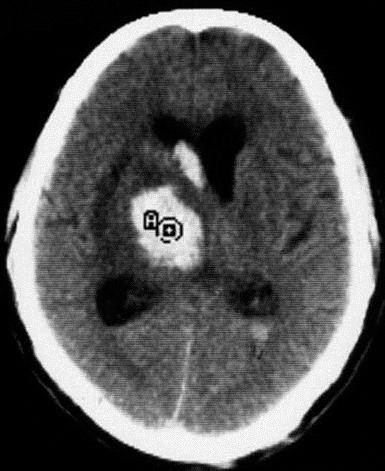 Intracerebral hematoma Being adjacent to the ventricle, intracerebral hematoma may or may not extend into the ventricle regardless the size of the lesion and the patient's age NCCT of a right