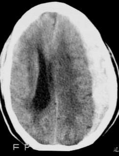 Subdural hematoma Can be acute, sub acute or chronic due to minor symptoms as it occurs in a wide