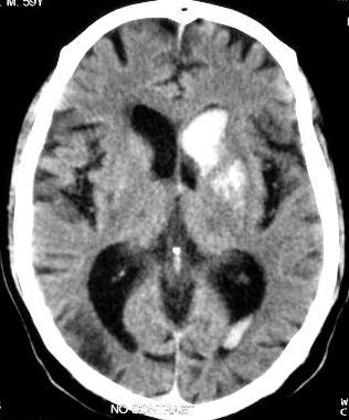 and interhemispheric fissures with intraventricular extension into the occipital horns NCCT of a recent left temporal