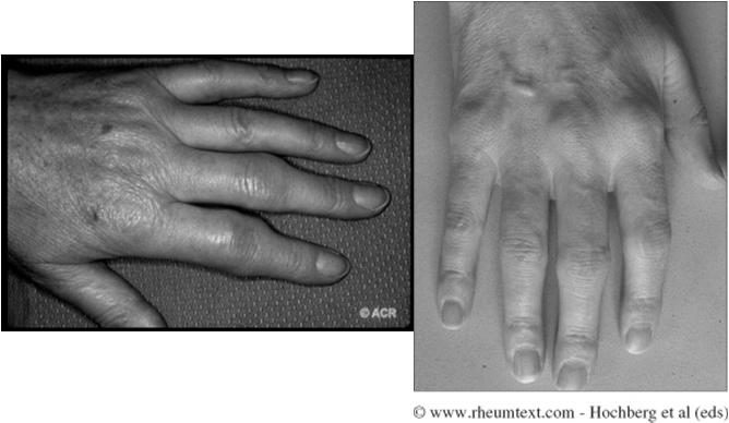 inflammation Unknown etiology Most common inflammatory arthritis Multisystem extra-articular manifestations Symmetrical arthritis that targets hands, wrists, feet,