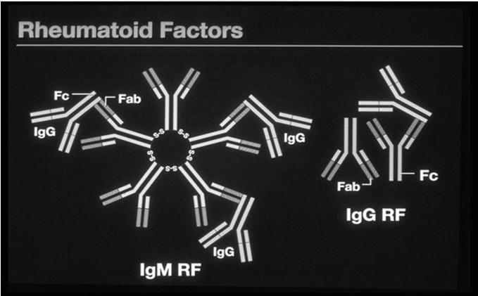 Rheumatoid Factors B-cells - plasma cells- produce RF Antiglobulin antibodies that bind to the Fc portions of IgG 75-80% of RA patients Locally produced in synovial tissue Found in SLE and bacterial