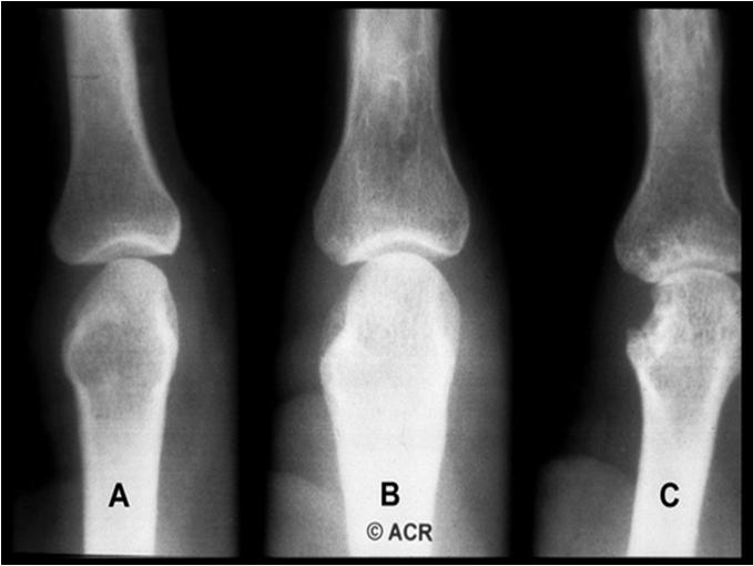 Compare the Radiographic Features of RA with those of OA RA OA Sclerosis ± + + + + Osteophytes ± + + + +
