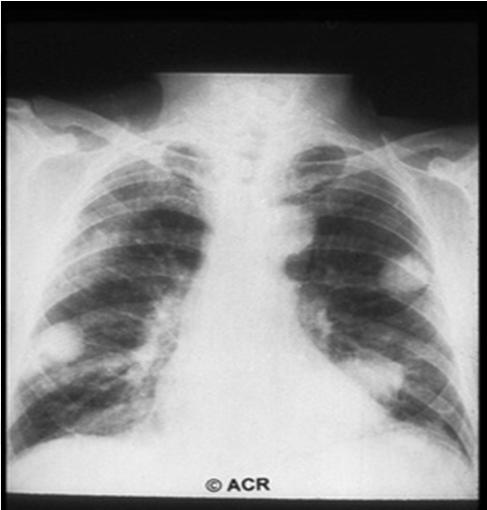 Interstitial Fibrosis Fibrosing alveolitis Smoker s are at high risk DLCO Fine diffuse dry rales BAL ( lymphocytes) ACR 2014 Classification Criteria for Patients must have four of seven criteria: -