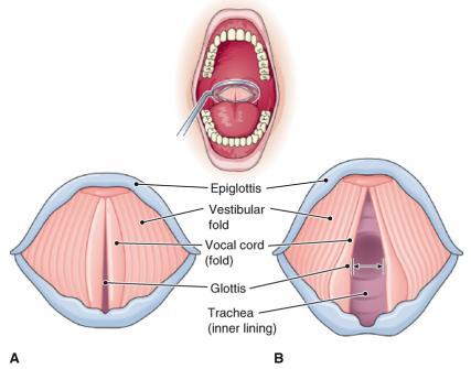 Figure 18-4 The vocal cords, superior view.