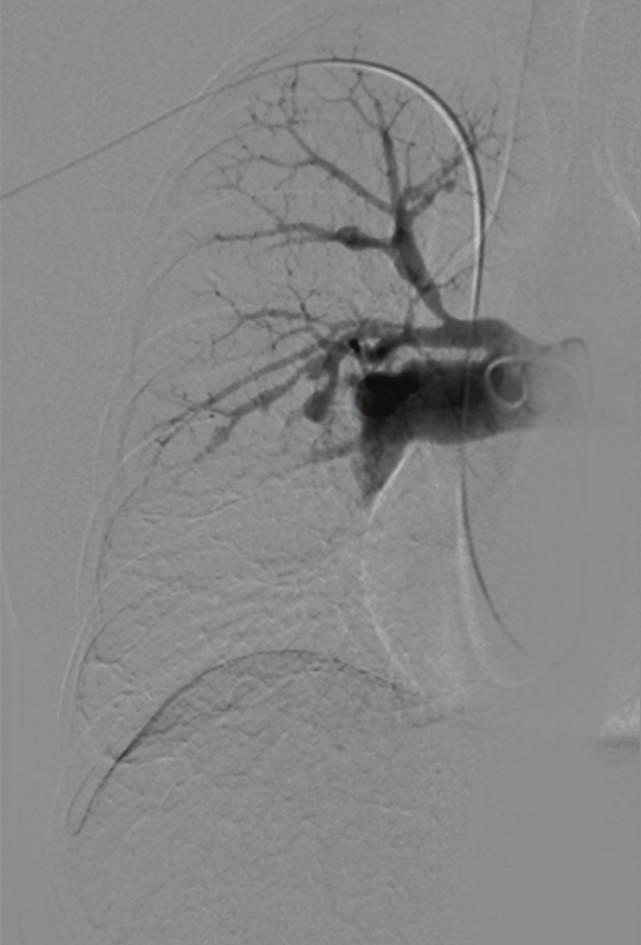2 Case Reports in Vascular Medicine (a) (b) (c) Figure 1: Pulmonary angiography suggestive for chronic thromboembolic pulmonary hypertension (CTEPH) with unexplained multiple dilatations of the