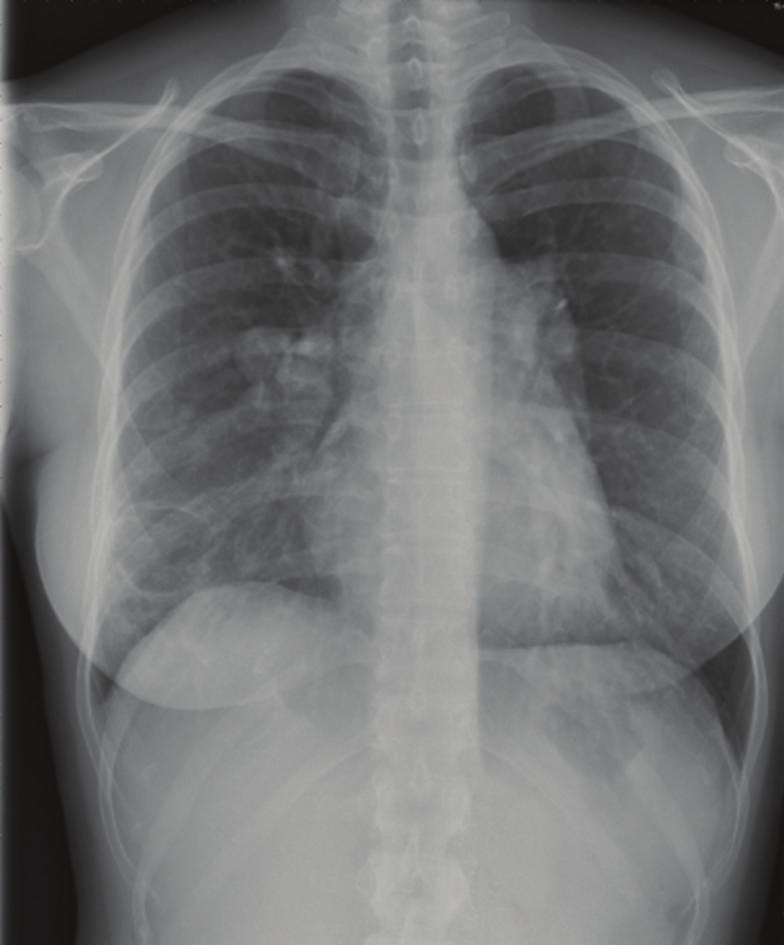 Case Reports in Vascular Medicine Figure 3: Follow-up chest X-ray shows a thin-walled cavitary lesion in the right lower lobe (white arrow).