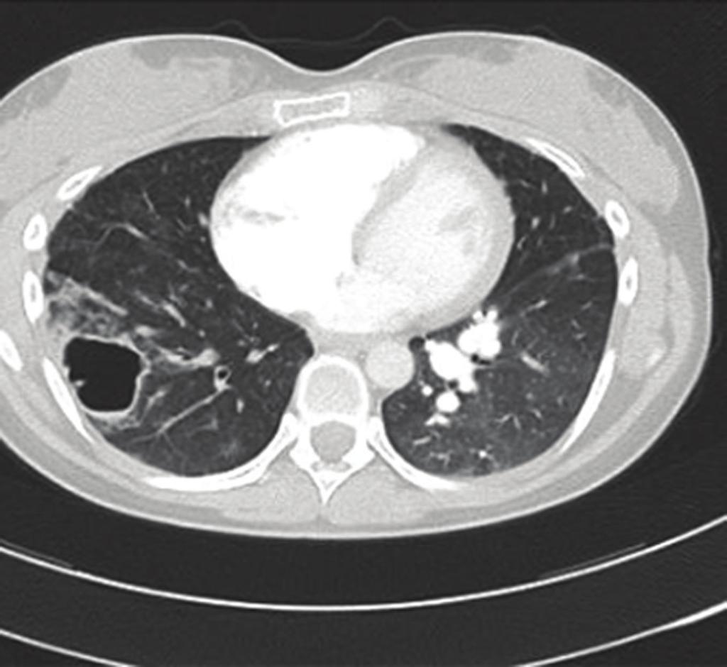 3 Figure 5: This section of the lung by autopsy showed a dilated vessel with tumor (intima sarcoma, rectangle) and extravascular extension of the tumor (circle). (Hematoxylin and eosin, 12.5). 2.