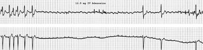 MANAGEMENT STRATEGIES FOR AF IN THE ICU Ventricular rate control: IV β-blocker, Ca ++ channel blocker, digoxin,