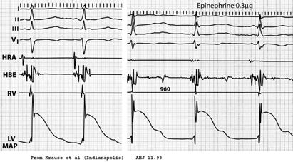 AFTERDEPOLARIZATIONS Early: Occur during 