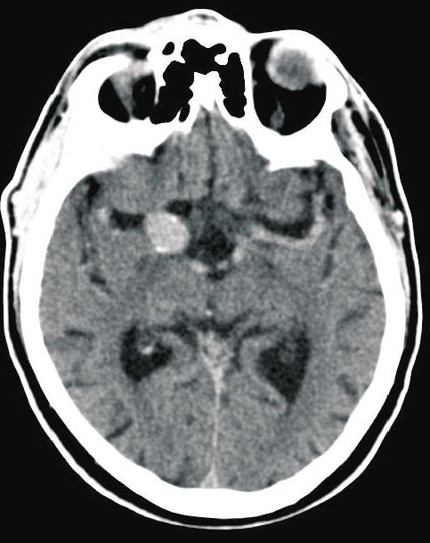 CE-MRA ( contrast enhanced MR Angiography ) that is obtained by intravenously injecting a paramagnetic substance Magnevist, Gadovist or Omniscan type (it contains Gadolinium) in 1 ml/kg body -dosage.