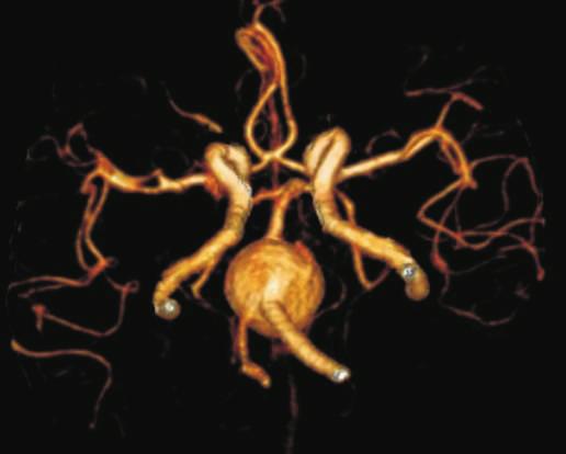 Fig. 7 MRA - Fussiform Basilar Artery Aneurysm Table 1 2008 and since 2006 MRA became first-choice diagnostic method for cerebral aneurysms, at present only special cases require complementary