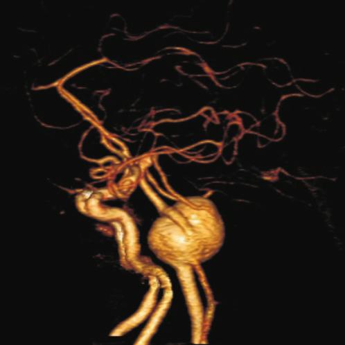 At the same time the number of cerebral aneurysms diagnosed with this method constantly grew (up to a maximum between 2006 and 2008) as well as the percentage of aneurysms diagnosed exclusively with