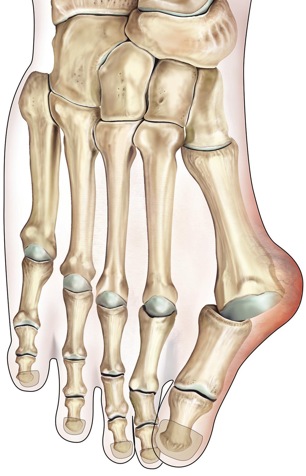 What is a bunion? A bunion is a bony lump on the side of your foot at the base of your big toe (see figure 1).