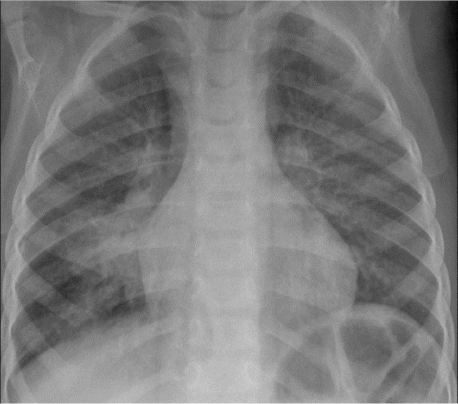 Primary Disease Typical of childhood TB Usually not cavitary Classic x-ray: