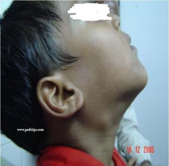 Clinical Case Cervical Lymphadenopathy 8 yr old with cervical lymphadenopathy History: LAN for 3 months PMHx: Healthy BCG vaccine at