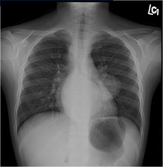 5 cm supraclavicular lymphadenopathy CXR: Hilar LAN, no infiltrates Is this TB disease? What else could it be?