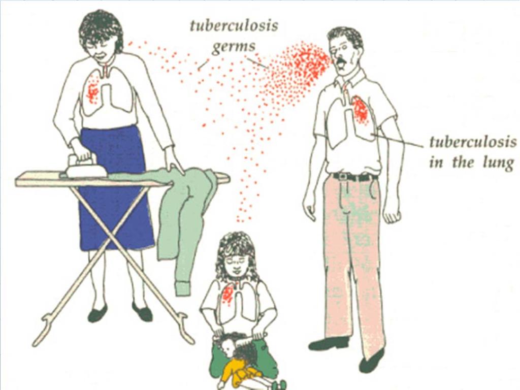 Stages of Tuberculosis Exposure to Contagious Adult with Pulmonary Disease Household contacts 20-30%