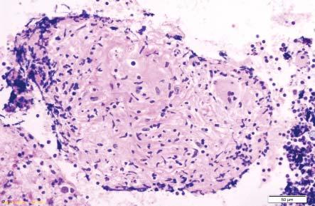 ...from previous page Figure 7a: A granuloma in the cellblock Case 3 (H&E x4) Figure 7b: Histology section showing a