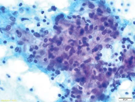 Likely sarcoidosis Cytology: Multinucleated giant cells containing asteroid bodies and Schaumann are present. Features in keeping with a diagnosis of Sarcoidosis.