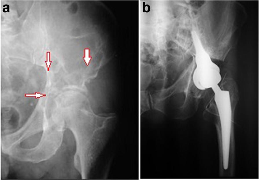 of cement. A standard stem of hip prosthesis was implanted after resection of a metastasis localized in the neck of the femur Karnofsky functional status score was 52.5 before the surgery and 71.