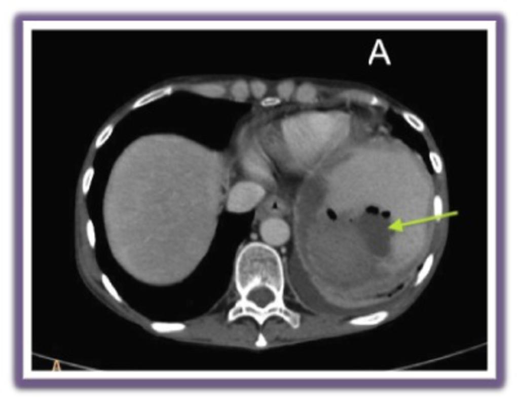 Fig. 9: A,B. 58-year-old man with abscess of left subphrenic space and left pleural efusión after total gastrectomy.