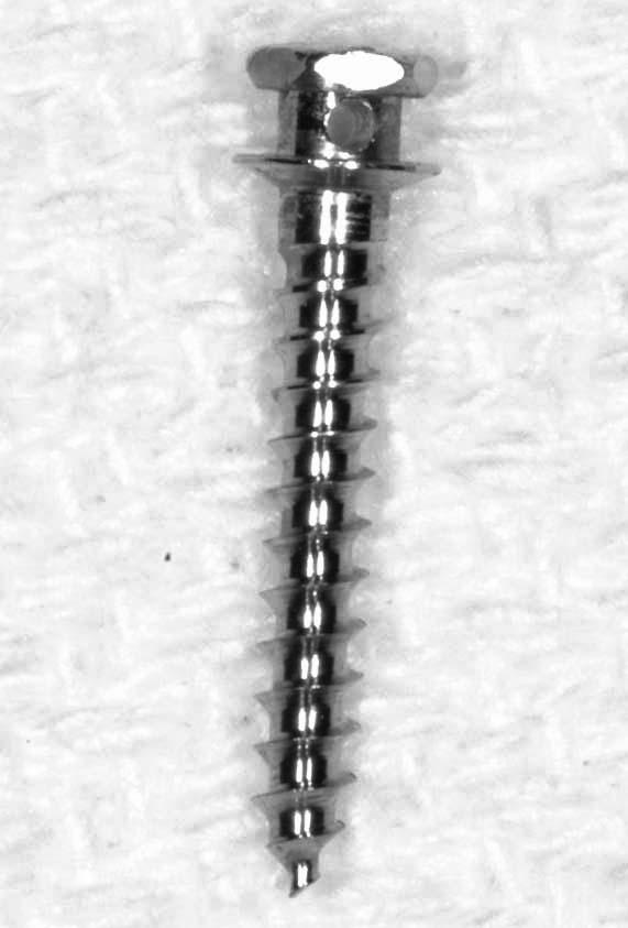 108 CHADDAD, FERREIRA, GEURS, REDDY Figure 2. Sandblasted, large grit, acid-etched. Figure 1. Machined titanium. characteristics under immediately applied continuous orthodontic loading.