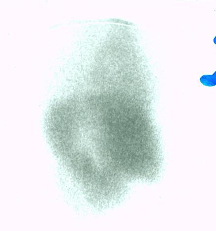 Liver scintigraphy with Tc-99m-colloid in case of