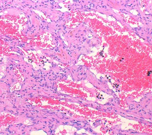 Mesenchymal Tumors MESENCHYMAL TUMORS OF THE LIVER: WHAT S NEW AND UNUSUAL (MY PERSPECTIVE) CURRENT ISSUES IN ANATOMIC PATHOLOGY MAY 23, 2014 Linda Ferrell, MD, UCSF Focus on Vascular Tumors Benign