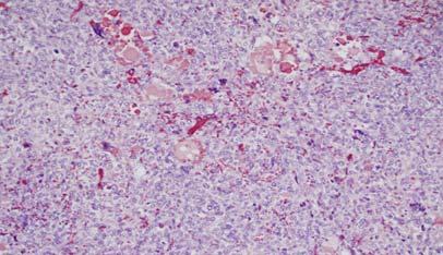 Undifferentiated (Embryonal) Sarcoma What else is NOT angiosarcoma Undifferentiated (Embryonal) Sarcoma of the Liver Typically younger patients; tumor of uncertain etiology Can be cystic due to