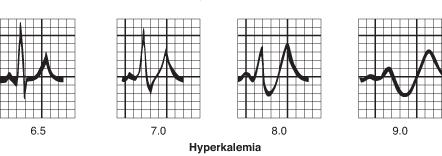 Hiperkalemija EKG: aukšti T danteliai, plokšti P danteliai, pailgėję PR intervalai, išplitę QRS kompleksai, bradikardija,