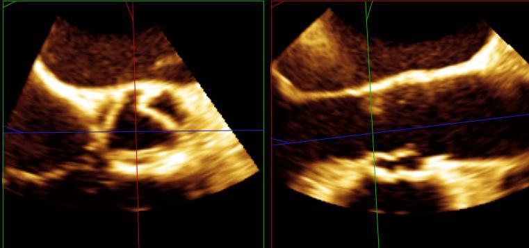 right coronary cusp and the edge of the commissures