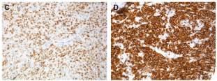 ) Major phenotypic changes: Diffuse large B-cell lymphoma COO