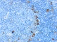 rich, B-cell lymphoma: CD20 Hodgkins lymphoma, LP: CD20 ClassicalHodgkin lymphoma, MC: CD30 Pattern: Membrane with dot-like Golgi CD30 in