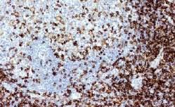 T-cell marker 70% cortical thymocytes Peripheral T-cells neagtive Langerhans cells / Interdigitating reticulum 50% precursor T-LB Langerhans