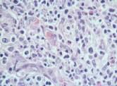 marginal zone B cells Most lymphomas CD4+ γδ TCL usually CD4- CD8- ALCL: CD4 > CD8 Double negs & double pos: aberrant = neoplastic?